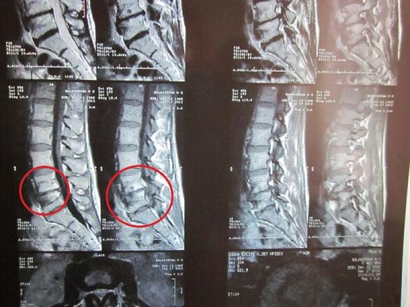 Diagnoza e osteokondrozës së qafës së mitrës
