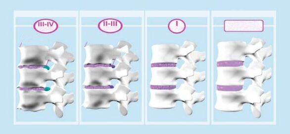 Fazat e osteokondrozës së qafës së mitrës