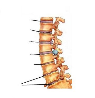 Si zhvillohet osteokondroza
