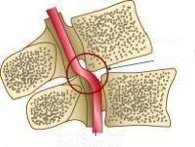 Sindromi i arterieve vail
