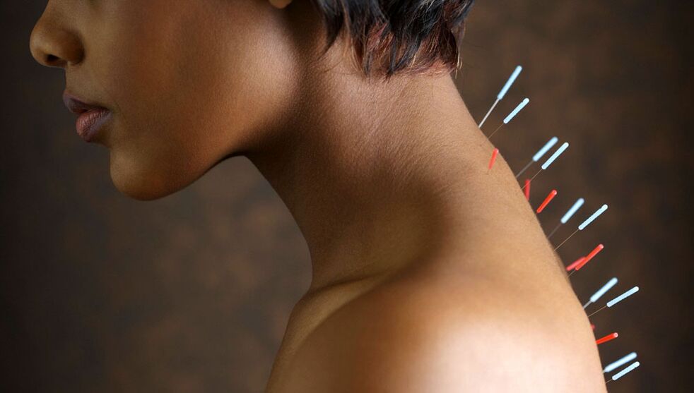 akupunkturë me osteokondrozë të qafës së mitrës