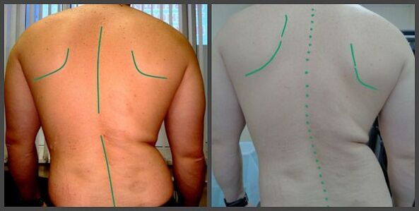 lakimi i shtyllës kurrizore me osteokondrozë