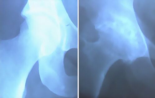 Copëza e artrozës së nyjës së gjurit