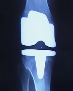 Foto x -Ray e gjurit me një protezë artificiale pas operacionit për të ndryshuar bashkimin