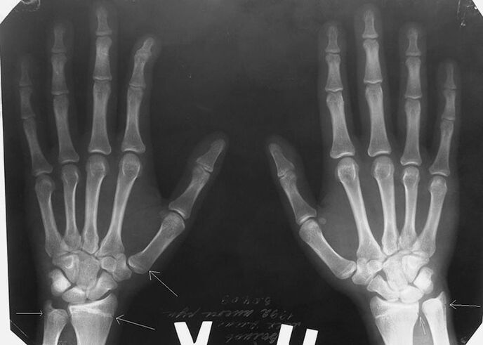 X-ray për dhimbje në kyçet e gishtave