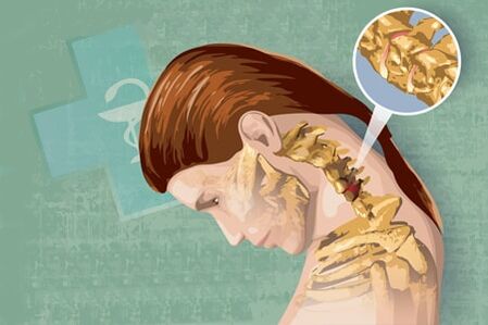 Simptomat refleksi të osteokondrozës